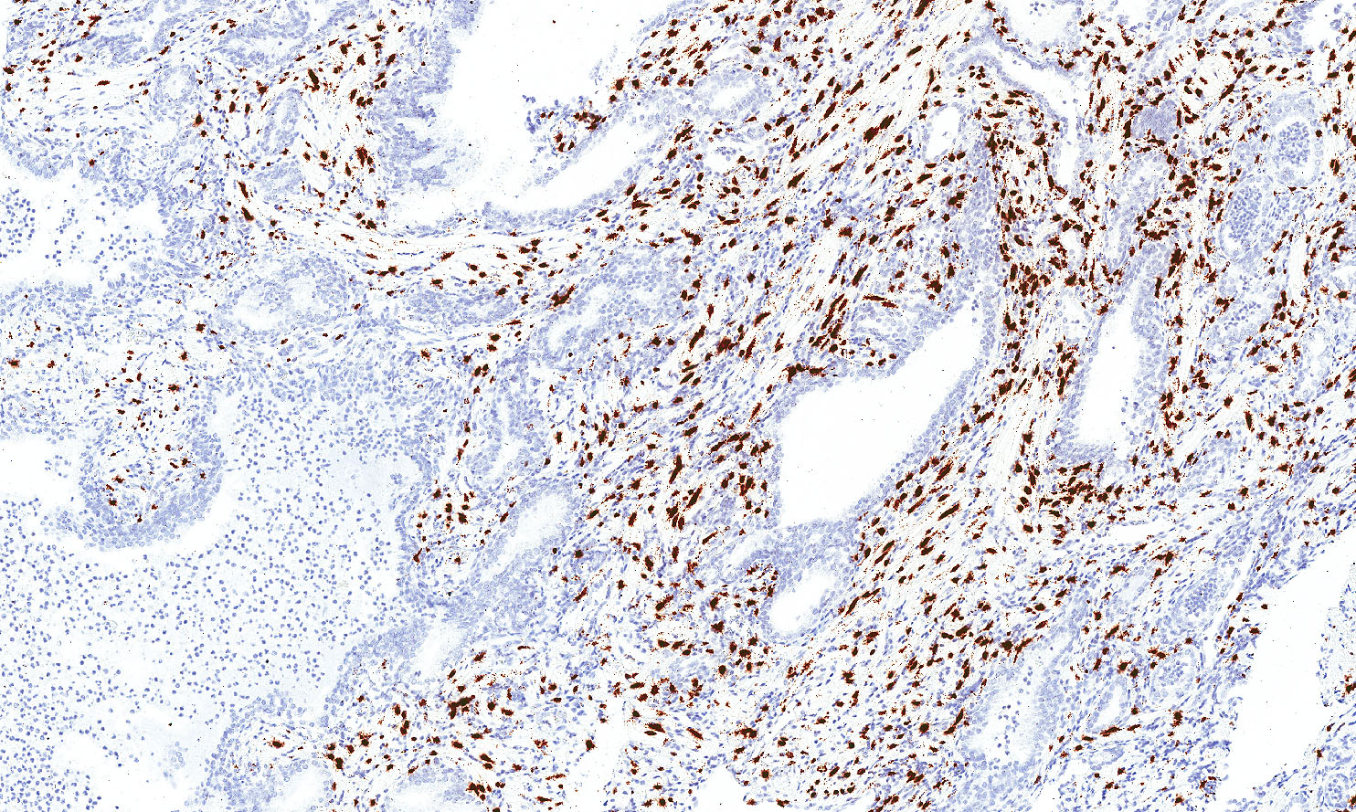 IL-6 mRNA-expressing cells (brown staining) are highly enriched in the stroma in areas of acute inflammation in the prostate.