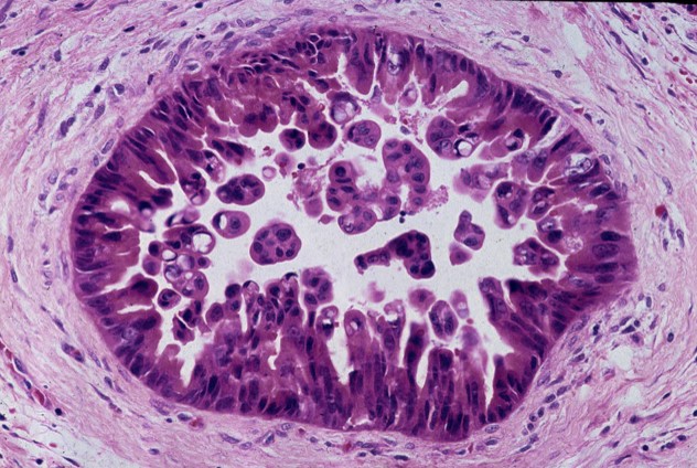 Pancreatic Cancer Precursor Lesions